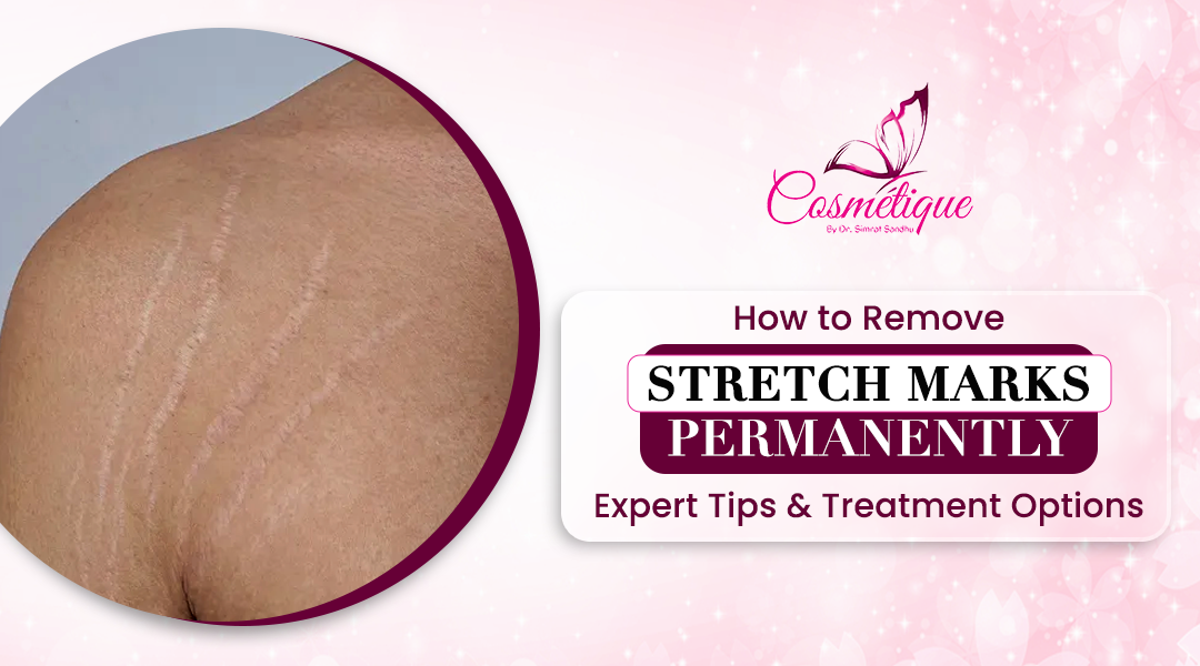 How to Remove Stretch Marks Permanently: Expert Tips & Treatment Options